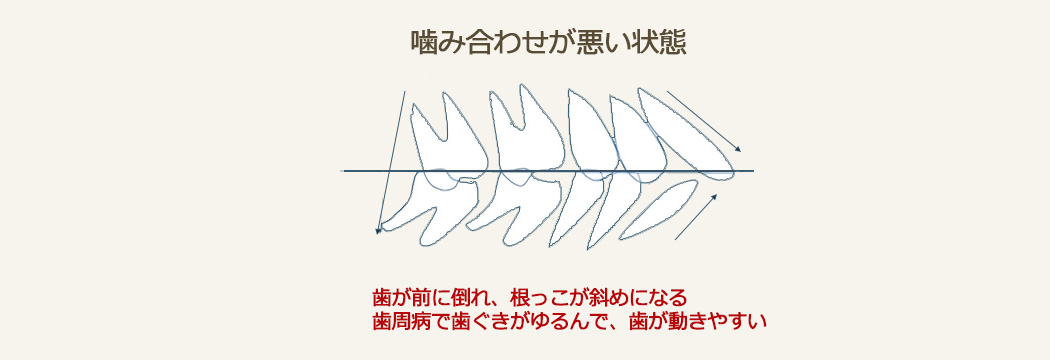 加齢により噛み合わせが悪くなった歯