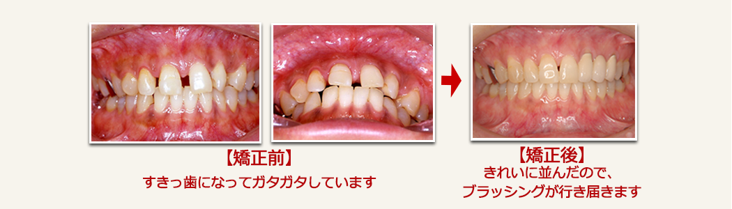 大人の矯正、ビフォーアフター